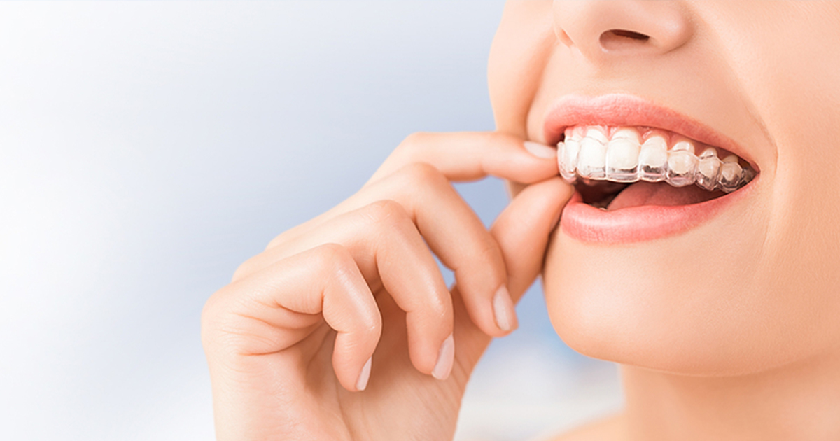 Emerald Dental - Mouthguards