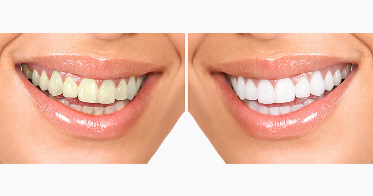 Teeth Whitening Emerald Dental - Teeth Whitening